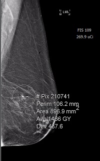 2018 Radioactive I-125 Seed Localization of Non-Palpable Breast Lesions at Florida Hospital Banner